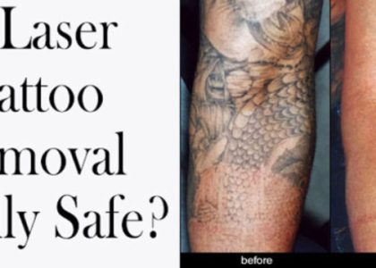 Tattoo Fade Using Tattoo Removing Creams