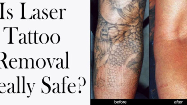 Tattoo Fade Using Tattoo Removing Creams