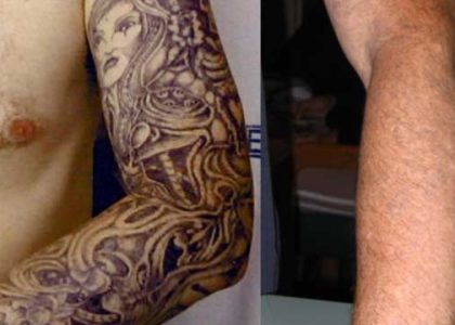 Tattoo Removers – What Could Be The Safest Tattoo Removal Plan?