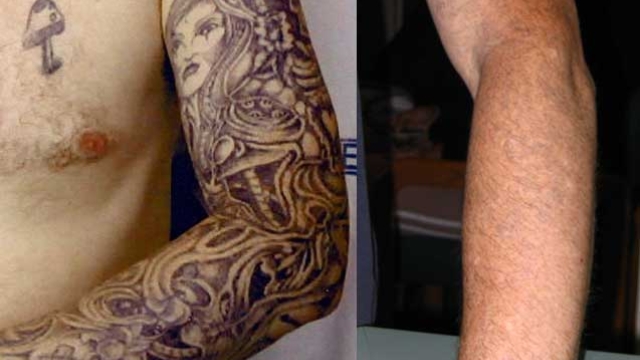 Tattoo Removers – What Could Be The Safest Tattoo Removal Plan?