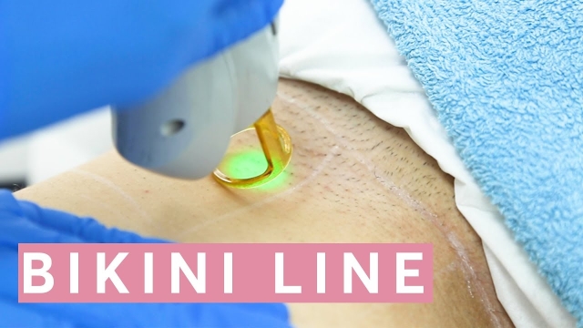 Breaking Free: Unmasking the Magic of Laser Hair Removal
