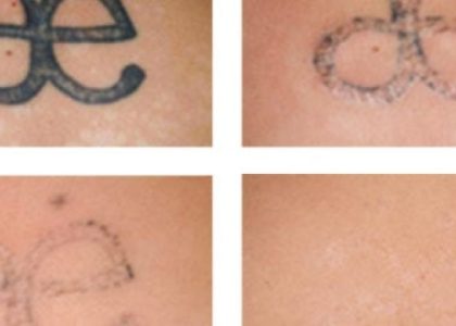Easy And Safe Tattoo Removal