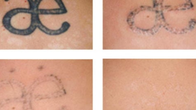 Easy And Safe Tattoo Removal