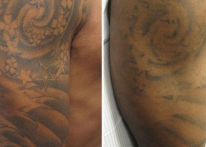Tattoo Removal Cream – Which Is A Better?