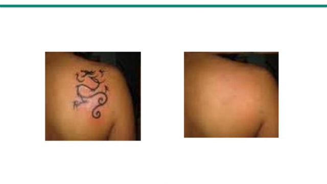 Tattoo Removal – Now It’s Getting Easier With A New Tattoo Ink