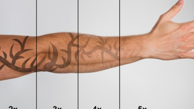 Tca Tattoo Removal – Removing A Shoulder Tattoo